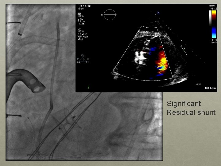 Significant Residual shunt 