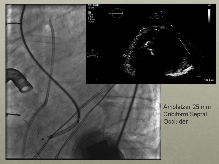 Amplatzer 25 mm Cribiform Septal Occluder 