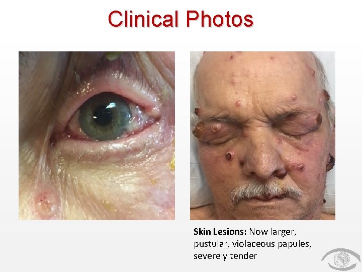 Clinical Photos Skin Lesions: Now larger, pustular, violaceous papules, severely tender 