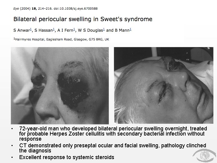  • • • 72 -year-old man who developed bilateral periocular swelling overnight, treated