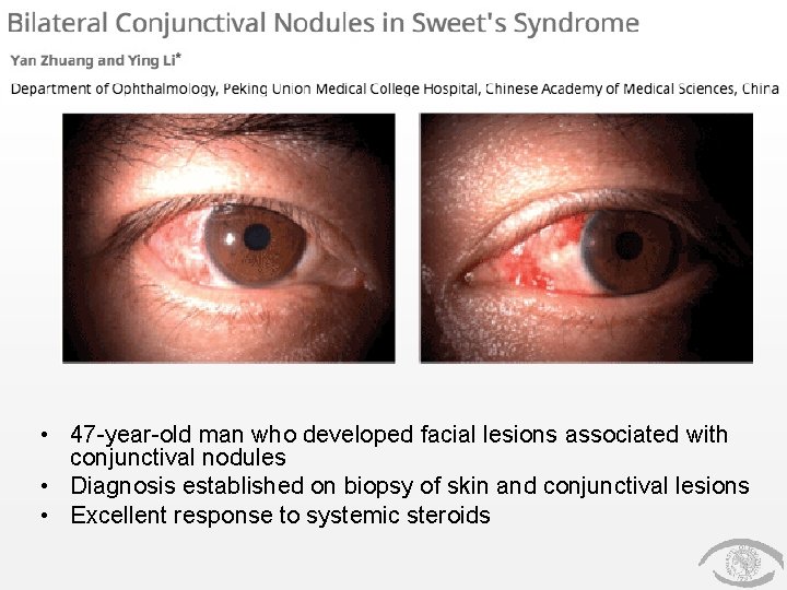  • 47 -year-old man who developed facial lesions associated with conjunctival nodules •