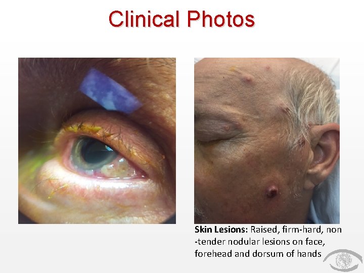 Clinical Photos Skin Lesions: Raised, firm-hard, non -tender nodular lesions on face, forehead and