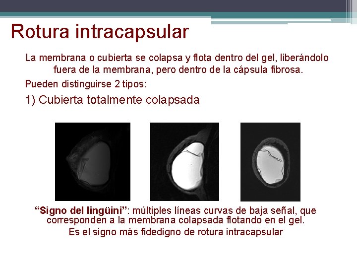 Rotura intracapsular La membrana o cubierta se colapsa y flota dentro del gel, liberándolo Rotura intracapsular La membrana o cubierta se colapsa y flota dentro del gel, liberándolo