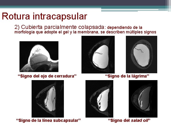 Rotura intracapsular 2) Cubierta parcialmente colapsada: dependiendo de la morfología que adopte el gel Rotura intracapsular 2) Cubierta parcialmente colapsada: dependiendo de la morfología que adopte el gel
