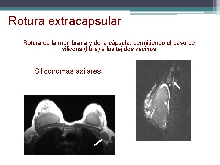 Rotura extracapsular Rotura de la membrana y de la cápsula, permitiendo el paso de Rotura extracapsular Rotura de la membrana y de la cápsula, permitiendo el paso de