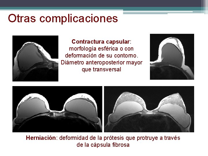 Otras complicaciones Contractura capsular: morfología esférica o con deformación de su contorno. Diámetro anteroposterior Otras complicaciones Contractura capsular: morfología esférica o con deformación de su contorno. Diámetro anteroposterior