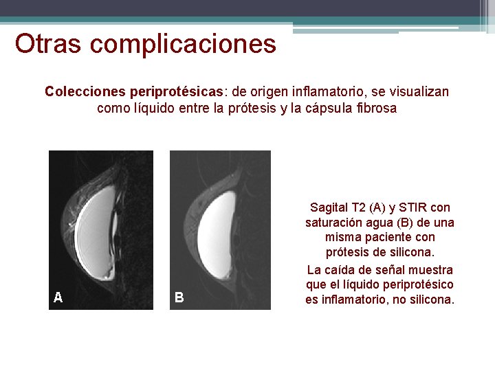 Otras complicaciones Colecciones periprotésicas: de origen inflamatorio, se visualizan como líquido entre la prótesis Otras complicaciones Colecciones periprotésicas: de origen inflamatorio, se visualizan como líquido entre la prótesis