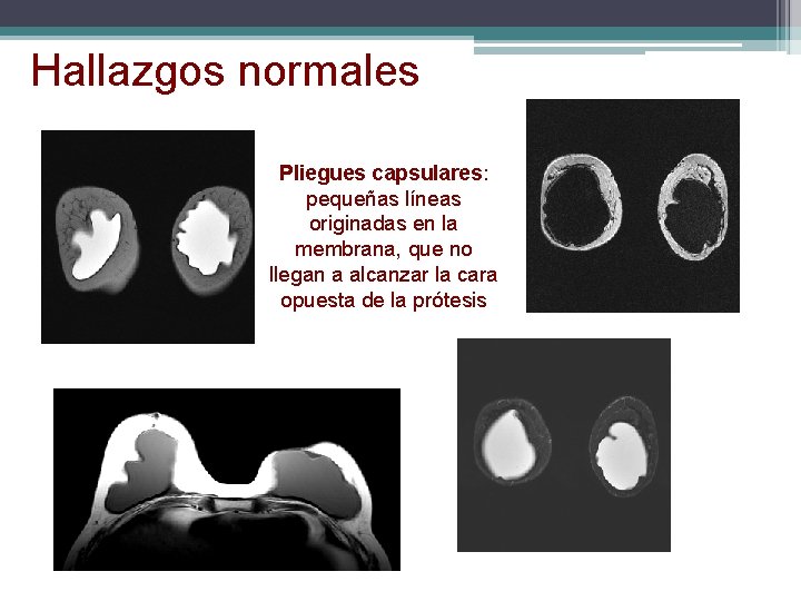 Hallazgos normales Pliegues capsulares: pequeñas líneas originadas en la membrana, que no llegan a Hallazgos normales Pliegues capsulares: pequeñas líneas originadas en la membrana, que no llegan a