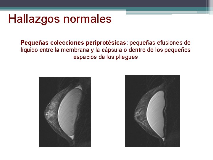 Hallazgos normales Pequeñas colecciones periprotésicas: pequeñas efusiones de líquido entre la membrana y la Hallazgos normales Pequeñas colecciones periprotésicas: pequeñas efusiones de líquido entre la membrana y la