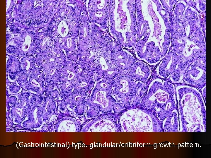 (Gastrointestinal) type. glandular/cribriform growth pattern. 