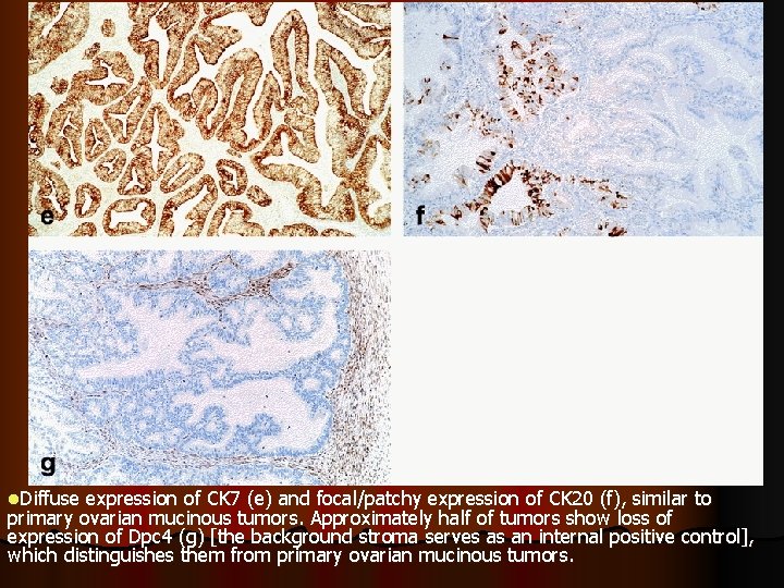l. Diffuse expression of CK 7 (e) and focal/patchy expression of CK 20 (f),
