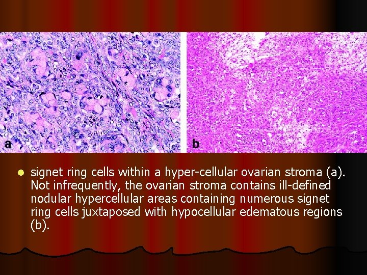 l signet ring cells within a hyper-cellular ovarian stroma (a). Not infrequently, the ovarian