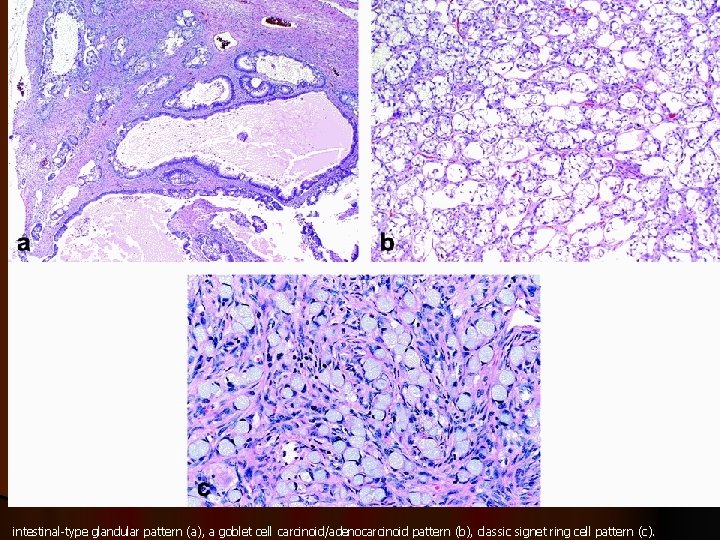 intestinal-type glandular pattern (a), a goblet cell carcinoid/adenocarcinoid pattern (b), classic signet ring cell