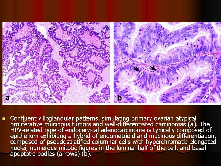 l Confluent villoglandular patterns, simulating primary ovarian atypical proliferative mucinous tumors and well-differentiated carcinomas