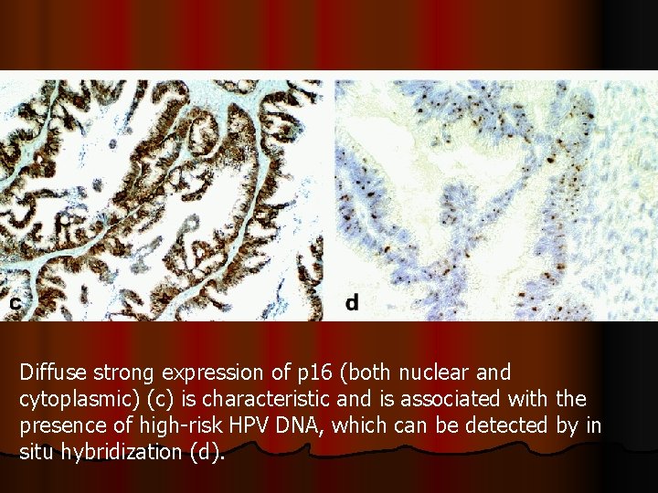 Diffuse strong expression of p 16 (both nuclear and cytoplasmic) (c) is characteristic and