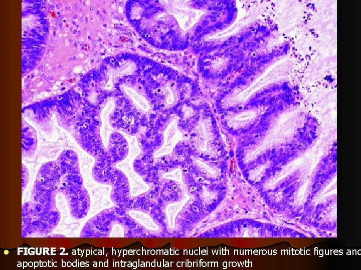 l FIGURE 2. atypical, hyperchromatic nuclei with numerous mitotic figures and apoptotic bodies and