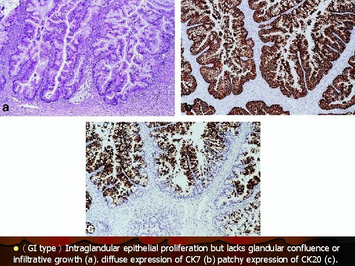 l（GI type）Intraglandular epithelial proliferation but lacks glandular confluence or infiltrative growth (a). diffuse expression