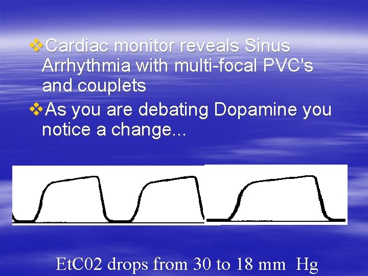 v. Cardiac monitor reveals Sinus Arrhythmia with multi-focal PVC's and couplets v. As you v. Cardiac monitor reveals Sinus Arrhythmia with multi-focal PVC's and couplets v. As you