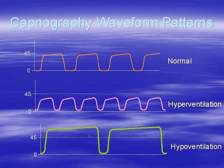 Capnography Waveform Patterns Normal 45 Hyperventilation 0 45 Hypoventilation 0 Capnography Waveform Patterns Normal 45 Hyperventilation 0 45 Hypoventilation 0
