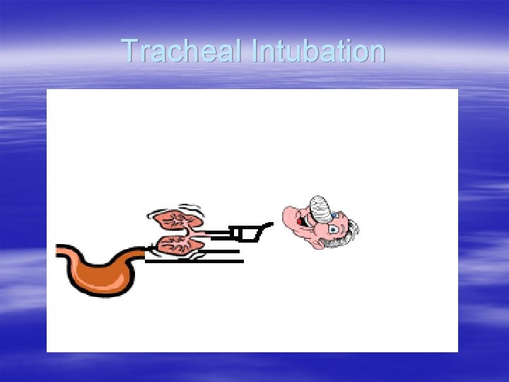Tracheal Intubation Tracheal Intubation