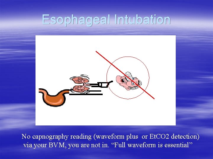 Esophageal Intubation No capnography reading (waveform plus or Et. CO 2 detection) via your Esophageal Intubation No capnography reading (waveform plus or Et. CO 2 detection) via your