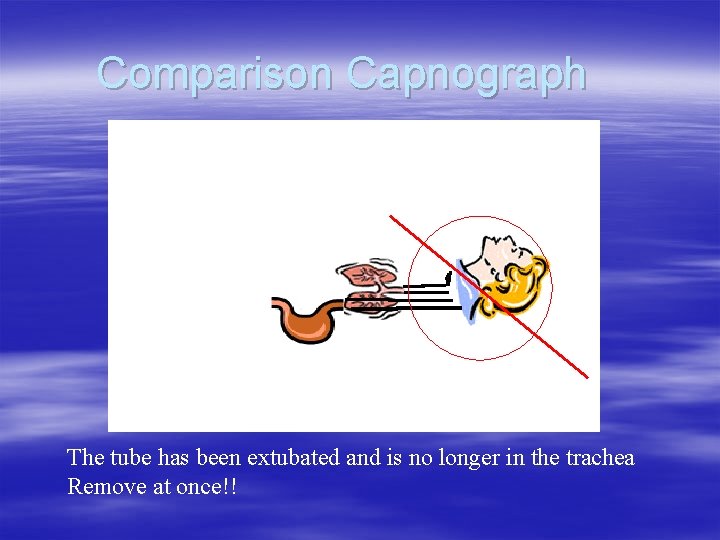 Comparison Capnograph The tube has been extubated and is no longer in the trachea Comparison Capnograph The tube has been extubated and is no longer in the trachea