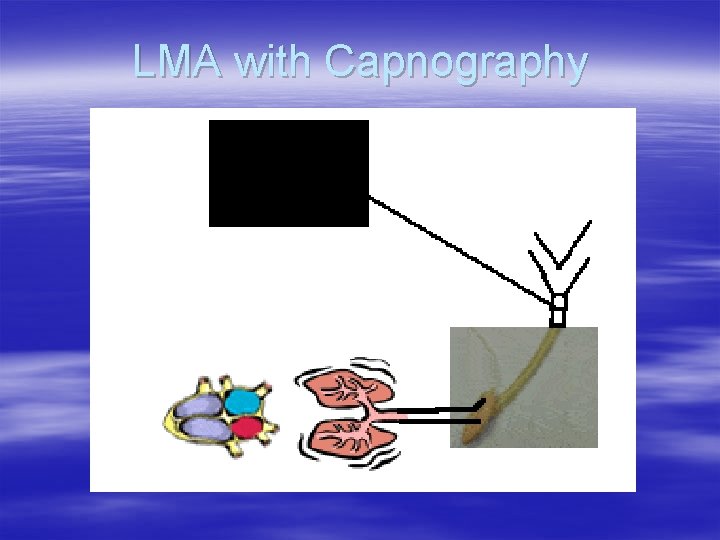 LMA with Capnography LMA with Capnography