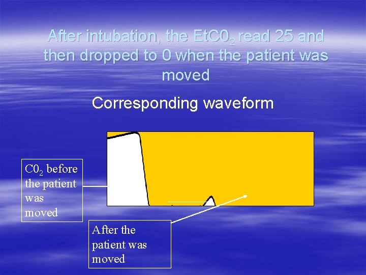 After intubation, the Et. C 02 read 25 and then dropped to 0 when After intubation, the Et. C 02 read 25 and then dropped to 0 when