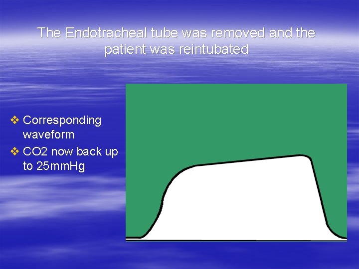 The Endotracheal tube was removed and the patient was reintubated v Corresponding waveform v The Endotracheal tube was removed and the patient was reintubated v Corresponding waveform v