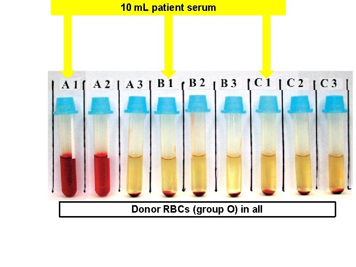 10 m. L patient serum Donor RBCs (group O) in all 