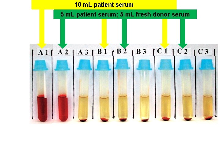 10 m. L patient serum 5 m. L patient serum; 5 m. L fresh