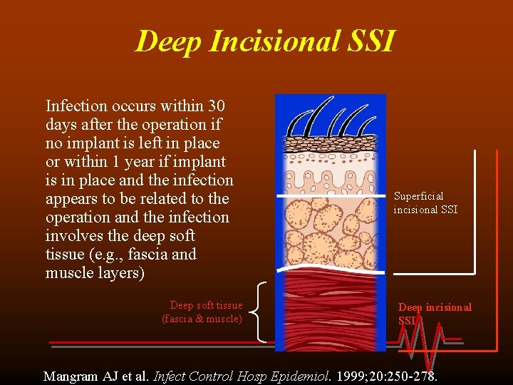 Deep Incisional SSI Infection occurs within 30 days after the operation if no implant