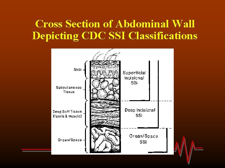 Cross Section of Abdominal Wall Depicting CDC SSI Classifications 