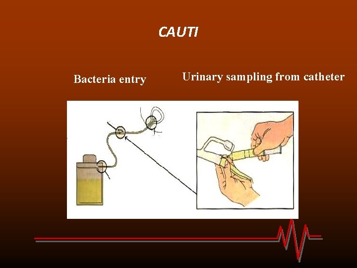 CAUTI Bacteria entry Urinary sampling from catheter 