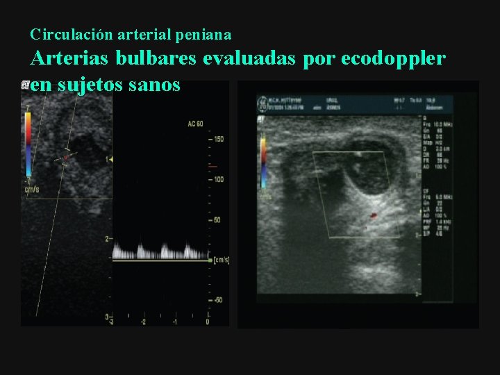 Circulación arterial peniana Arterias bulbares evaluadas por ecodoppler en sujetos sanos 