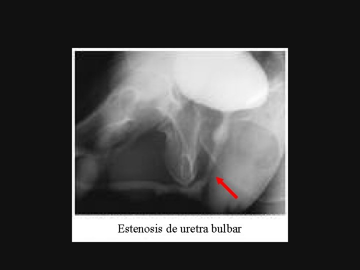 Estenosis de uretra bulbar 