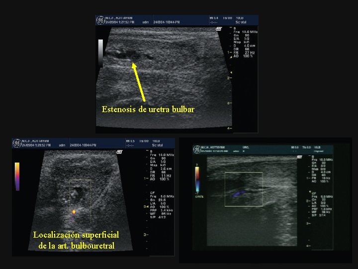 Estenosis de uretra bulbar Localización superficial de la art. bulbouretral 