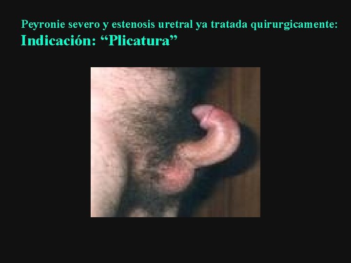 Peyronie severo y estenosis uretral ya tratada quirurgicamente: Indicación: “Plicatura” 