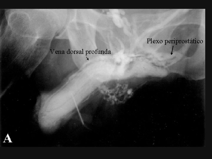 Plexo periprostático Vena dorsal profunda 