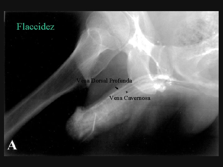 Flaccidez Vena Dorsal Profunda Vena Cavernosa 