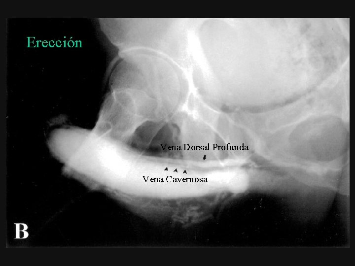Erección Vena Dorsal Profunda Vena Cavernosa 