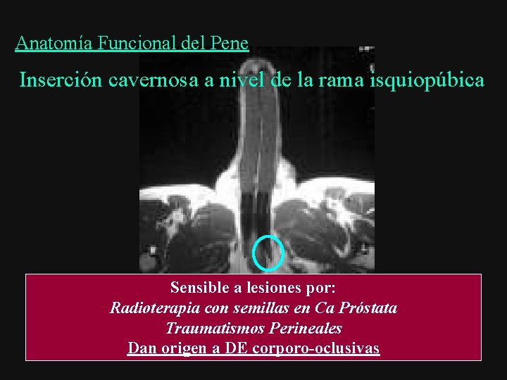 Anatomía Funcional del Pene Inserción cavernosa a nivel de la rama isquiopúbica Sensible a