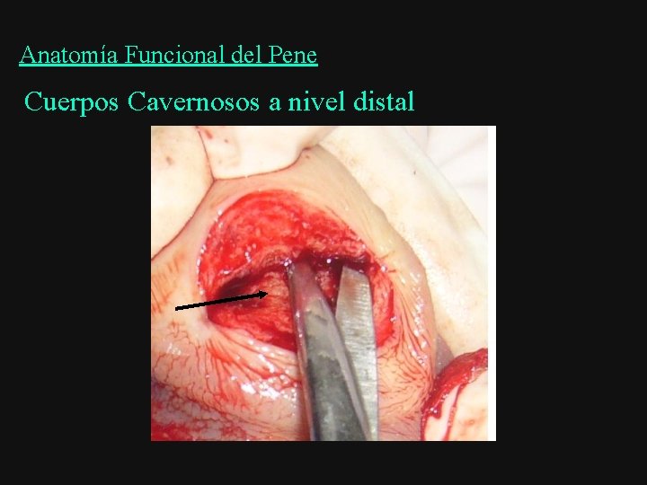 Anatomía Funcional del Pene Cuerpos Cavernosos a nivel distal 