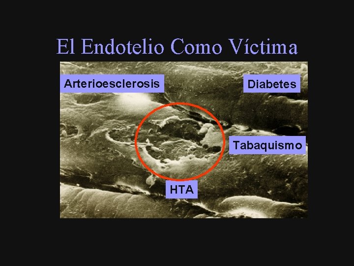 El Endotelio Como Víctima Arterioesclerosis Diabetes Tabaquismo HTA 