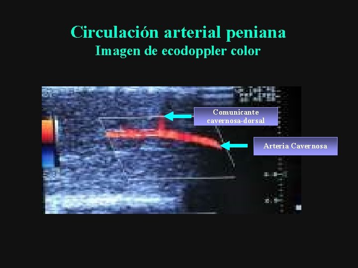Circulación arterial peniana Imagen de ecodoppler color Comunicante cavernosa-dorsal Arteria Cavernosa 