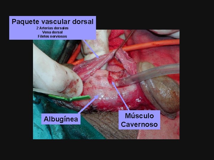 Paquete vascular dorsal 2 Arterias dorsales Vena dorsal Filetes nerviosos Albugínea Músculo Cavernoso 