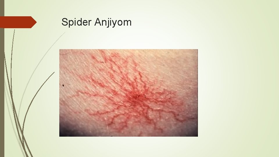 Spider Anjiyom 
