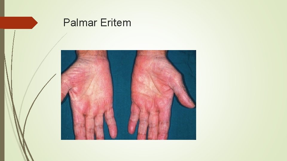 Palmar Eritem 