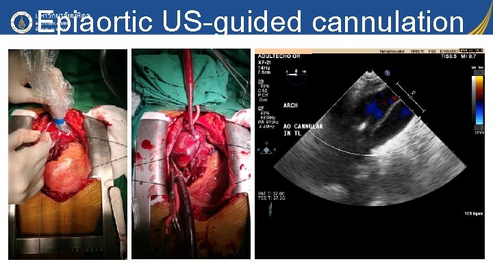 Epiaortic US-guided cannulation 