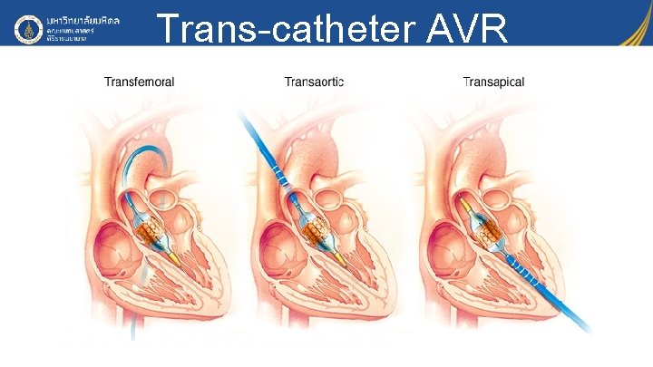 Trans-catheter AVR 